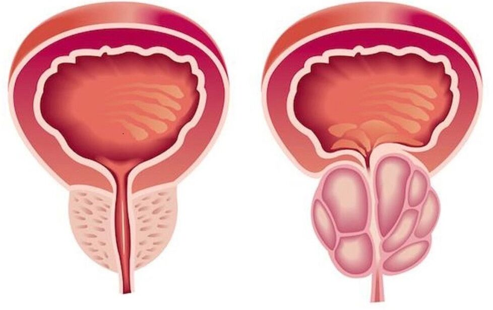 υγιής και φλεγμονώδης προστάτης με προστατίτιδα